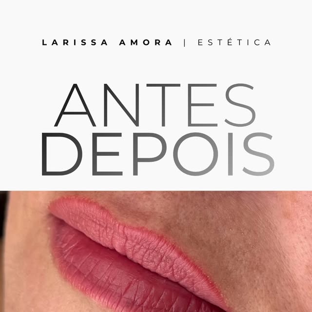 Resultado de preenchimento labial realizado pela Dra. Larissa Amora