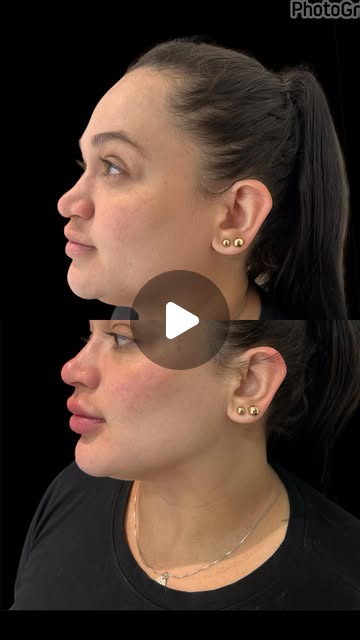 Antes e depois de preenchimento de malar realizado pela Dra. Larissa Amora